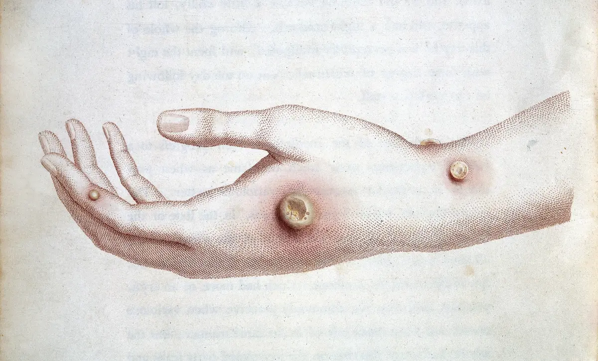Jenner's smallpox vaccine